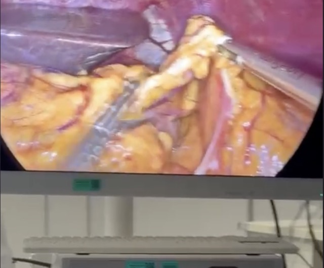 Laparoskopik Cerrahi